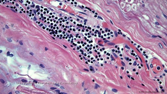 Mikroskopische Aufnahmen von Richard Westgates Nervengewebe. Jeder schwarze Punkt ist eine tote Nervenzelle. - Aufnahme aus dem Film "<a href=